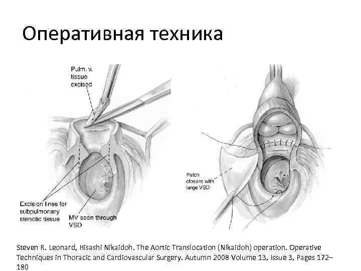 Оперативная техника Steven R. Leonard, Hisashi Nikaidoh. The Aortic Translocation (Nikaidoh) operation. Operative Techniques