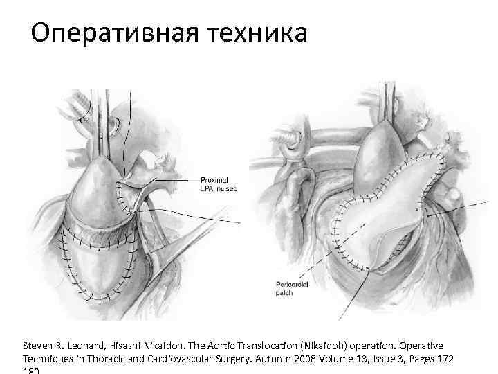 Оперативная техника Steven R. Leonard, Hisashi Nikaidoh. The Aortic Translocation (Nikaidoh) operation. Operative Techniques