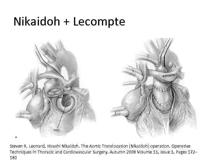 Nikaidoh + Lecompte Steven R. Leonard, Hisashi Nikaidoh. The Aortic Translocation (Nikaidoh) operation. Operative