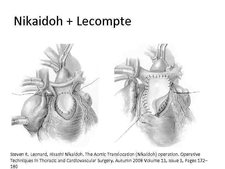 Nikaidoh + Lecompte Steven R. Leonard, Hisashi Nikaidoh. The Aortic Translocation (Nikaidoh) operation. Operative
