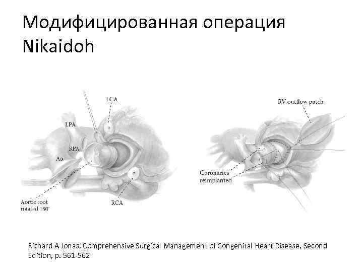 Модифицированная операция Nikaidoh Richard A Jonas, Comprehensive Surgical Management of Congenital Heart Disease, Second