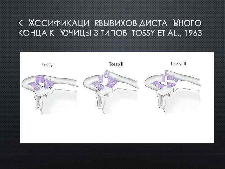 КЛАССИФИКАЦИЯ ВЫВИХОВ ДИСТАЛЬНОГО КОНЦА КЛЮЧИЦЫ 3 ТИПОВ TOSSY ET AL. , 1963 