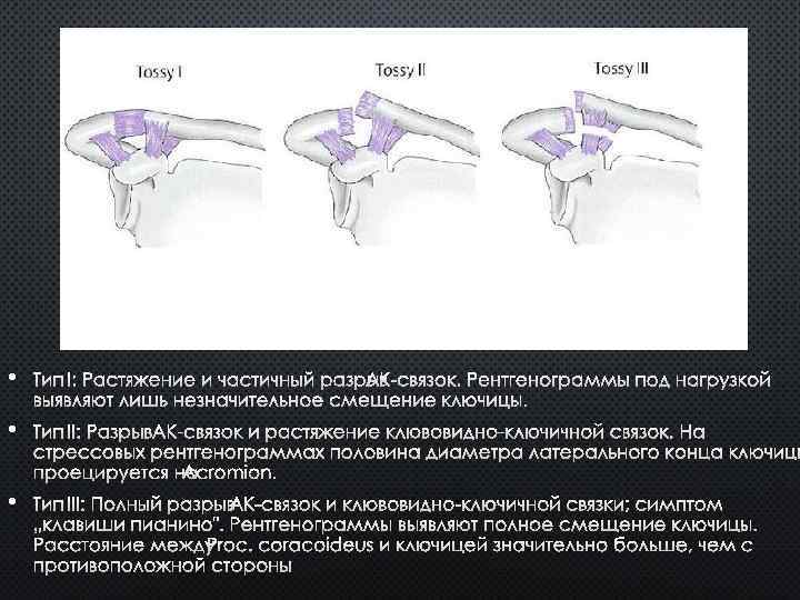 Повреждение акромиально ключичного