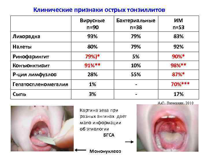 Клинические признаки острых тонзиллитов Вирусные n=90 Бактериальные n=38 ИМ n=53 Лихорадка 93% 79% 83%