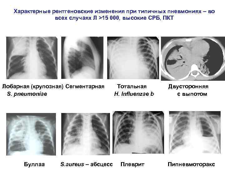 Рентгенологическая картина пневмонии у детей