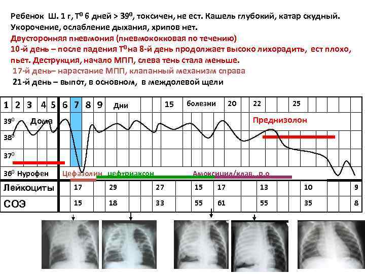Ребенок Ш. 1 г, Т 0 6 дней > 390, токсичен, не ест. Кашель