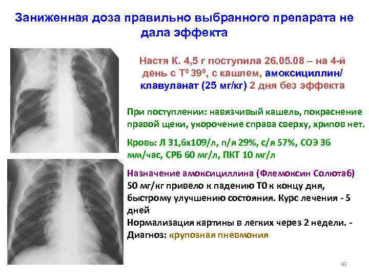 Схема лечения пневмоцистной пневмонии