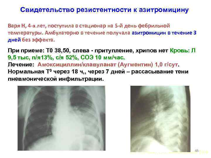 Свидетельство резистентности к азитромицину Варя Н, 4 -х лет, поступила в стационар на 5