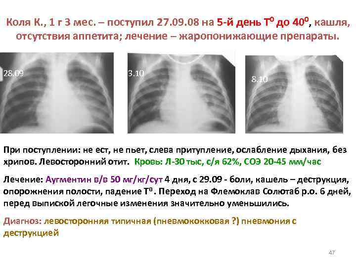 Коля К. , 1 г 3 мес. – поступил 27. 09. 08 на 5