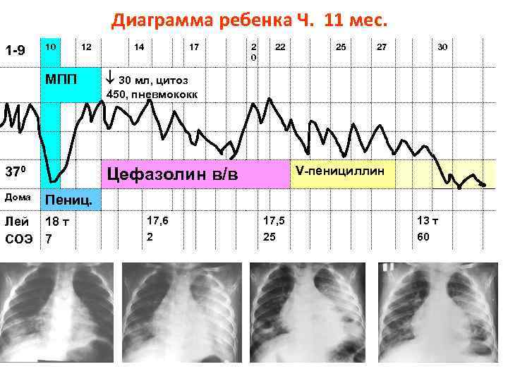 Диаграмма ребенка Ч. 11 мес. 1 -9 10 12 МПП 14 17 2 0