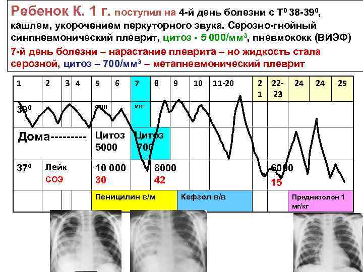 Ребенок К. 1 г. поступил на 4 -й день болезни с Т 0 38