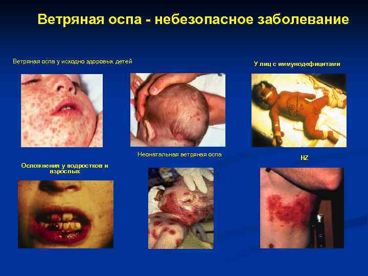 Ветряная оспа - небезопасное заболевание Ветряная оспа у исходно здоровых детей У лиц с