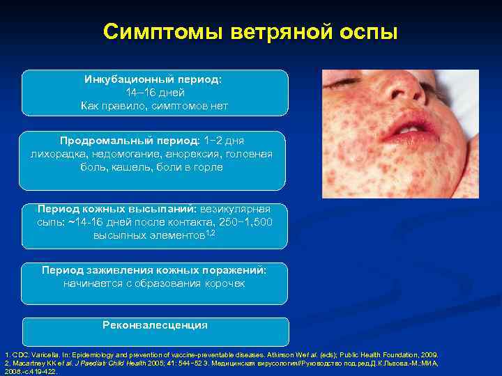 Симптомы ветряной оспы Инкубационный период: 14– 16 дней Как правило, симптомов нет Продромальный период: