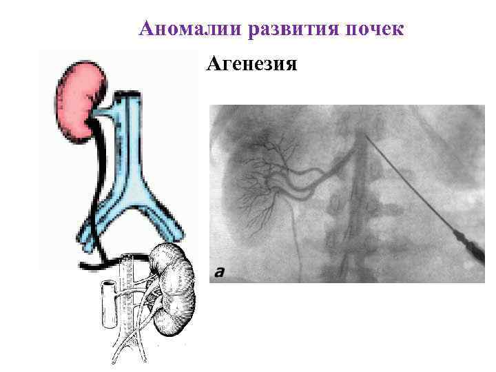 Аномалии развития почек Агенезия 