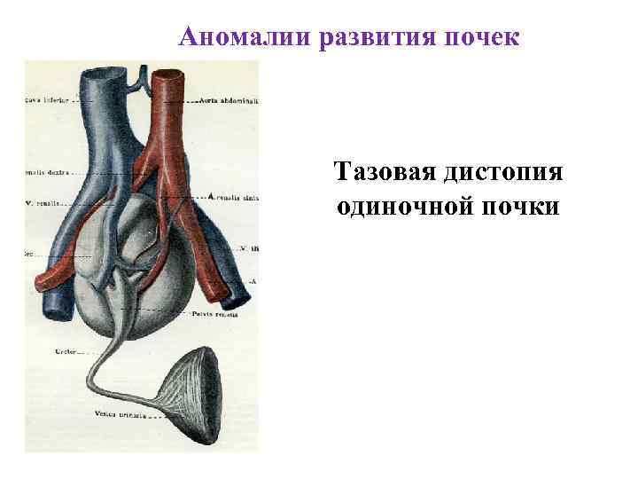 Аномалии развития почек Тазовая дистопия одиночной почки 