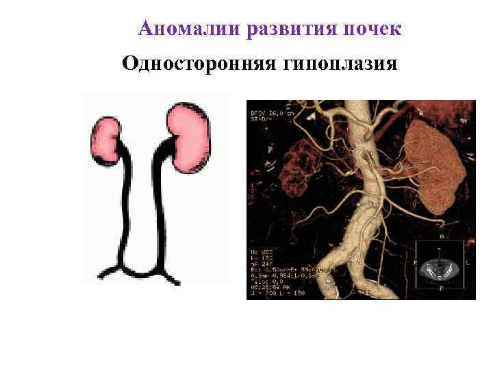 Аномалии развития почек Односторонняя гипоплазия 