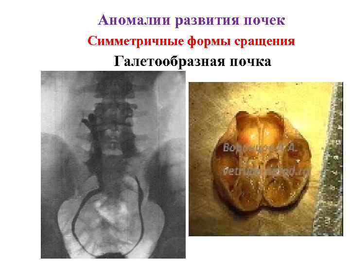 Аномалии развития почек Симметричные формы сращения Галетообразная почка 