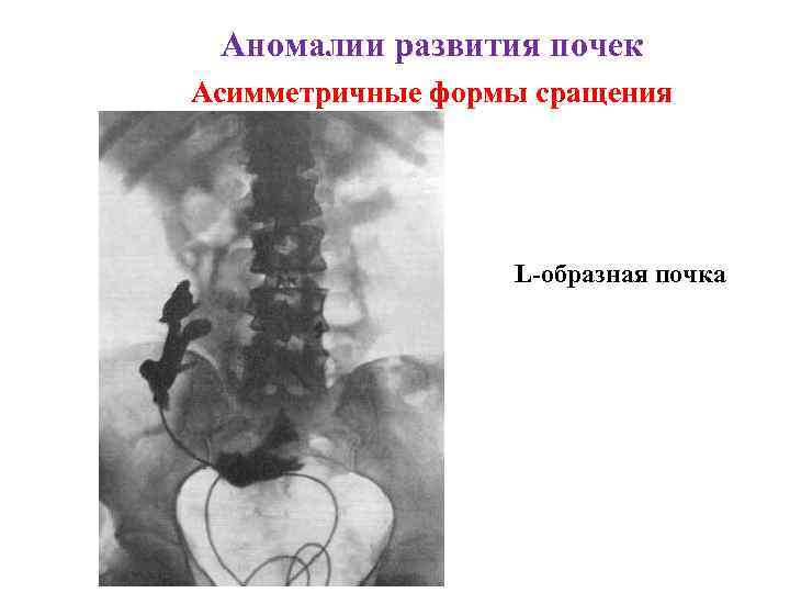 Аномалии развития почек Асимметричные формы сращения L-образная почка 