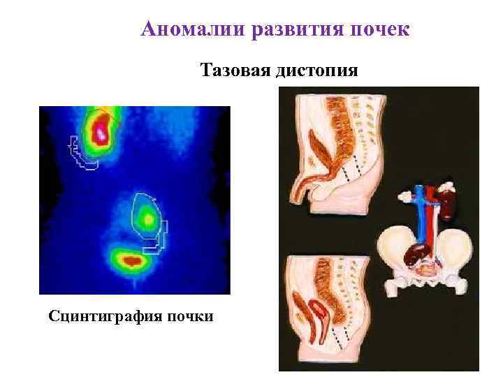 Аномалии развития почек Тазовая дистопия Сцинтиграфия почки 