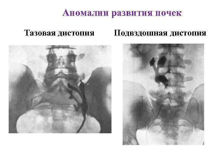 Аномалии развития почек Тазовая дистопия Подвздошная дистопия 