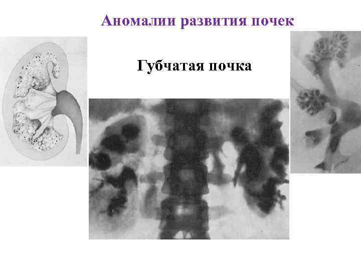 Аномалии развития почек Губчатая почка 