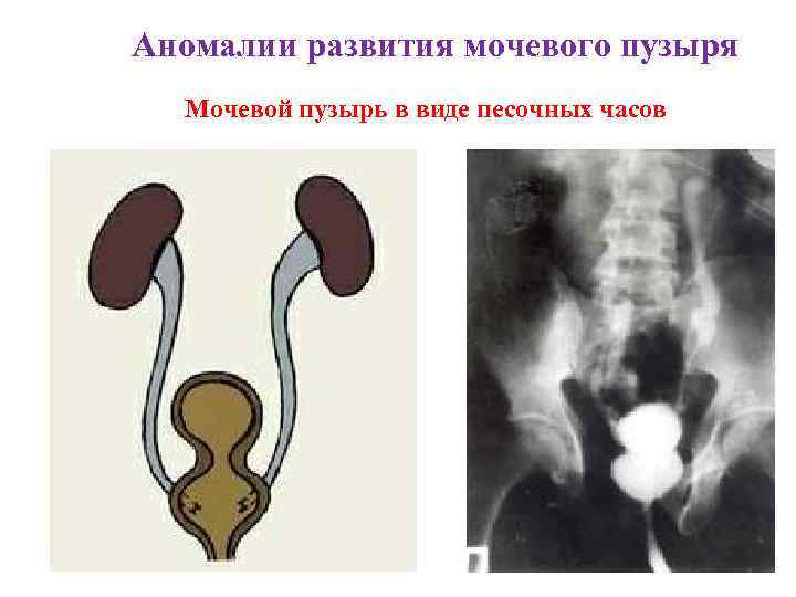 Аномалии развития мочевого пузыря Мочевой пузырь в виде песочных часов 