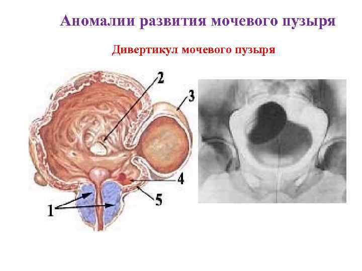 Аномалии развития мочевого пузыря Дивертикул мочевого пузыря 
