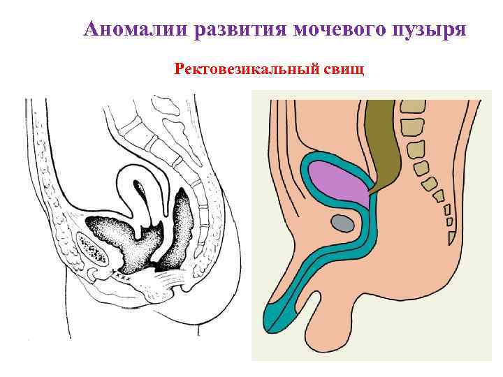 Аномалии развития мочевого пузыря Ректовезикальный свищ 