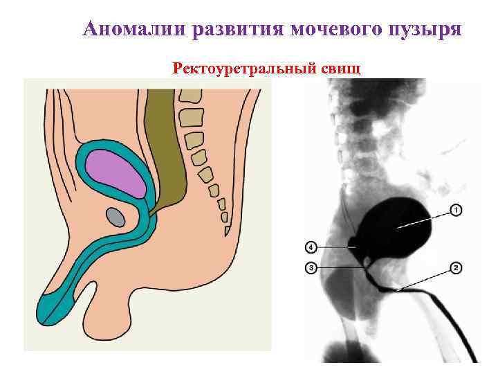 Аномалии развития мочевого пузыря Ректоуретральный свищ 