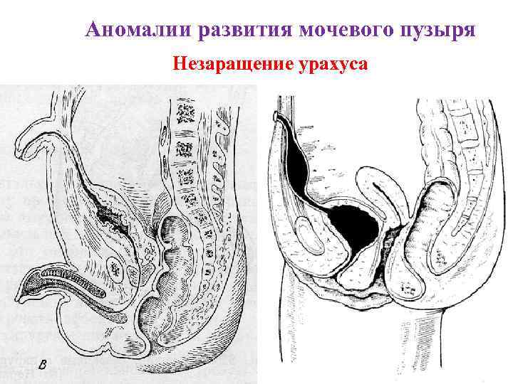 Аномалии развития мочевого пузыря Незаращение урахуса 