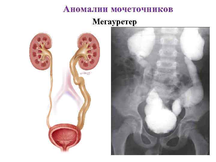 Аномалии мочеточников Мегауретер 