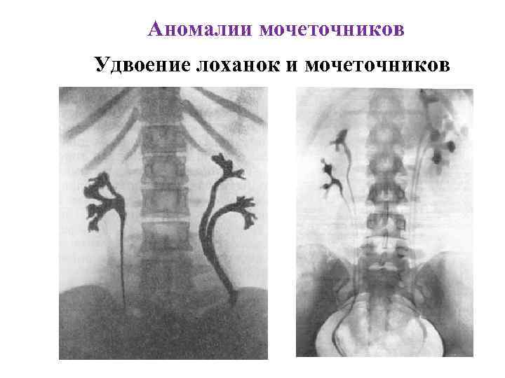 Аномалии мочеточников Удвоение лоханок и мочеточников 