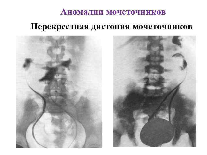 Аномалии мочеточников Перекрестная дистопия мочеточников 