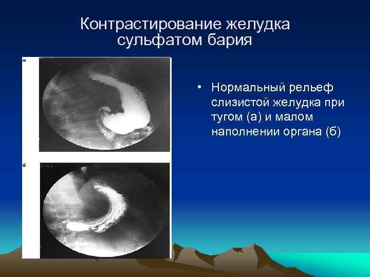 Контрастирование желудка сульфатом бария • Нормальный рельеф слизистой желудка при тугом (а) и малом
