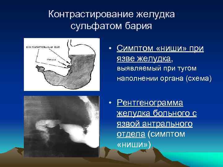 Контрастирование желудка сульфатом бария • Симптом «ниши» при язве желудка, выявляемый при тугом наполнении