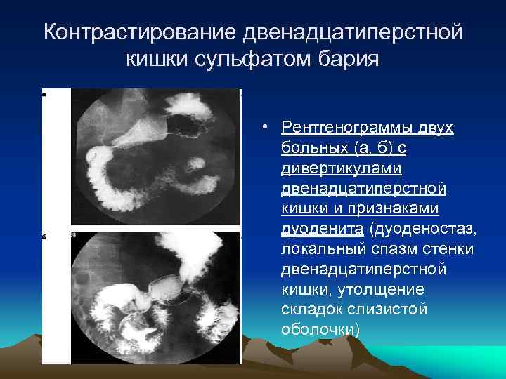 Контрастирование двенадцатиперстной кишки сульфатом бария • Рентгенограммы двух больных (а, б) с дивертикулами двенадцатиперстной