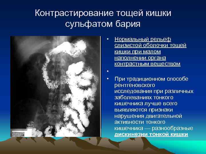 Контрастирование тощей кишки сульфатом бария • Нормальный рельеф слизистой оболочки тощей кишки при малом