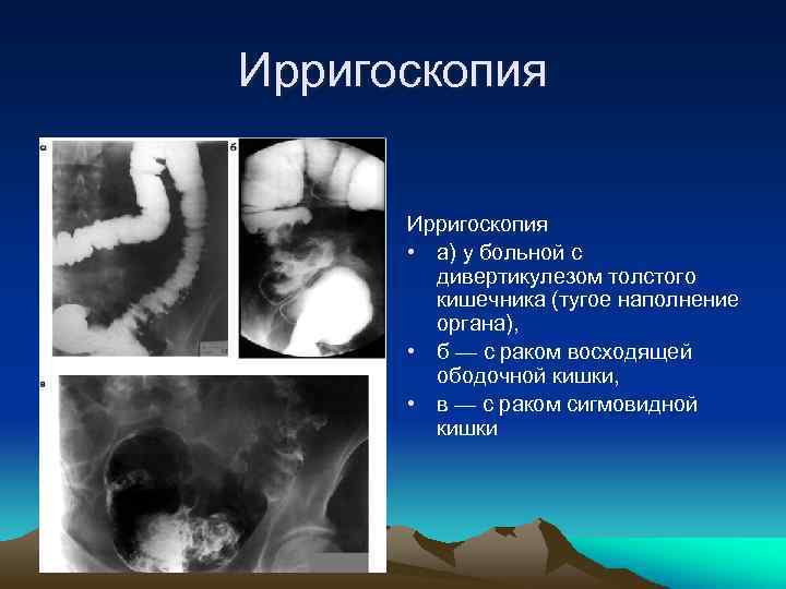 Ирригоскопия • а) у больной с дивертикулезом толстого кишечника (тугое наполнение органа), • б