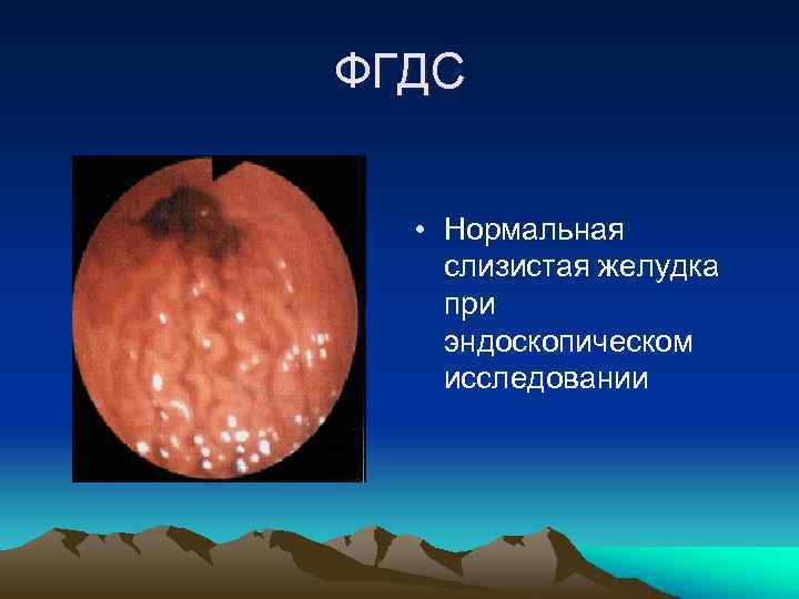 ФГДС • Нормальная слизистая желудка при эндоскопическом исследовании 