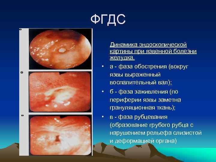 ФГДС Динамика эндоскопической картины при язвенной болезни желудка. • а - фаза обострения (вокруг