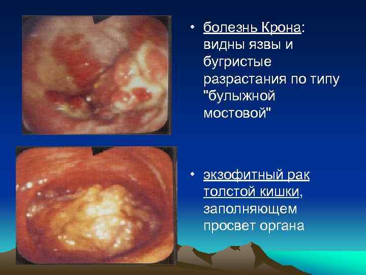  • болезнь Крона: видны язвы и бугристые разрастания по типу "булыжной мостовой" •