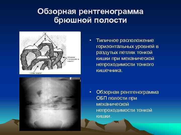 Обзорная рентгенограмма брюшной полости • Типичное расположение горизонтальных уровней в раздутых петлях тонкой кишки