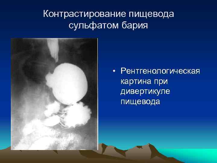 Контрастирование пищевода сульфатом бария • Рентгенологическая картина при дивертикуле пищевода 