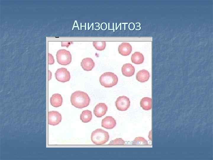 Анизоцитоз 