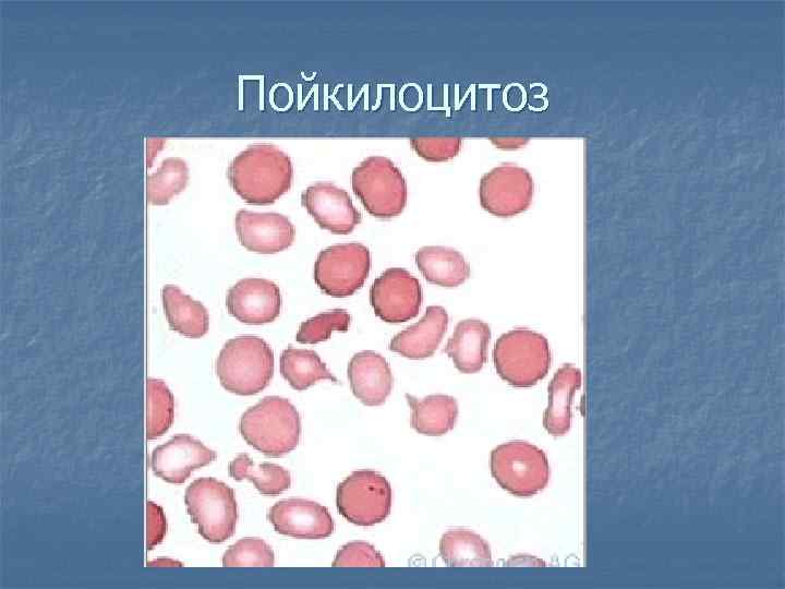 Пойкилоцитоз 