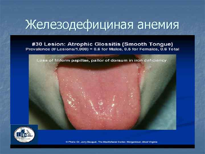 Железодефициная анемия 