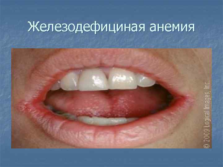 Железодефициная анемия 