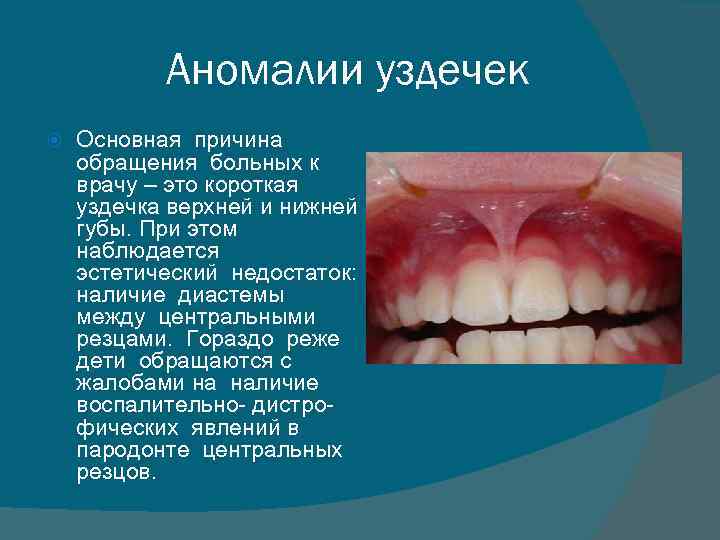 Аномалии уздечек Основная причина обращения больных к врачу – это короткая уздечка верхней и