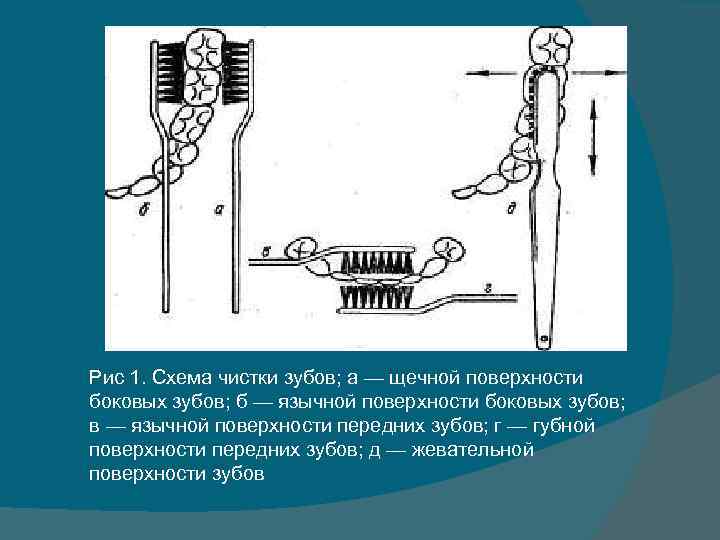 Рис 1. Схема чистки зубов; а — щечной поверхности боковых зубов; б — язычной