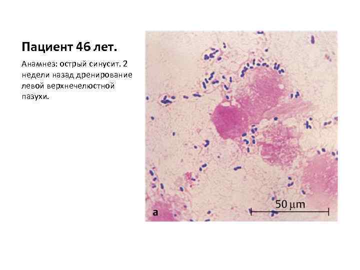 Пациент 46 лет. Анамнез: острый синусит. 2 недели назад дренирование левой верхнечелюстной пазухи. 